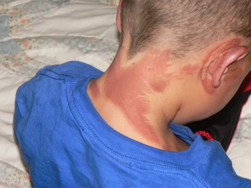 Burns on the back of the neck.