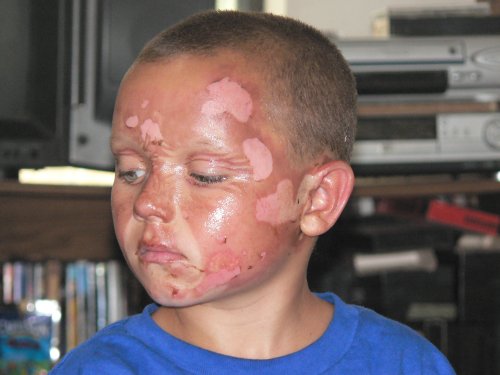 An 8 year old boy with severe facial burns 3 days after the incident.